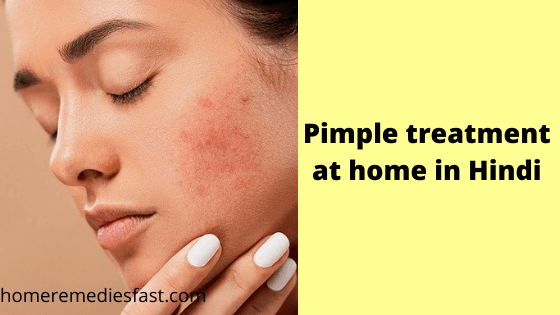Pimple treatment at home in Hindi